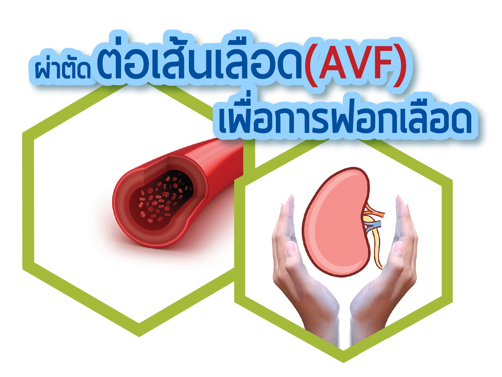 ผ่าตัดต่อเส้นเลือด เพื่อการฟอกเลือด (AVF)