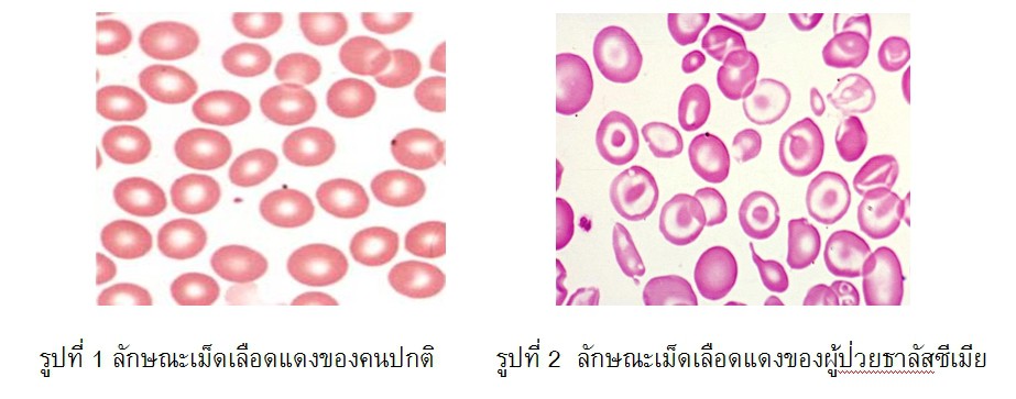 มารู้จักโรคเลือดจางธาลัสซีเมียกันเถอะ