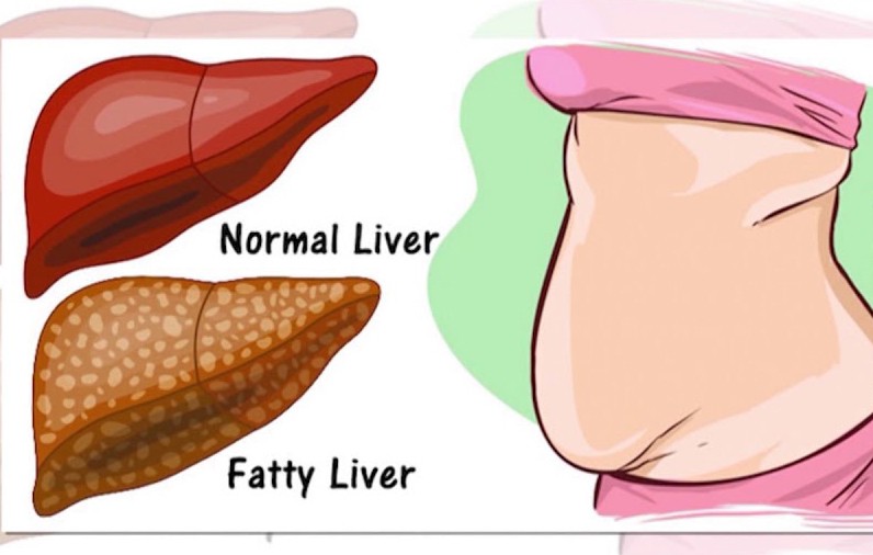 ไขมันคั่ง สะสมในตับ (Non-alcoholic steatohepatitis)