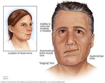 โรคหลอดเลือดสมอง (Stroke)