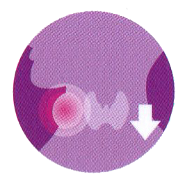 โรคไทรอยด์ชนิดอ้วน ภาวะพร่องฮอร์โมนไทรอยด์ (Hypothyroid)