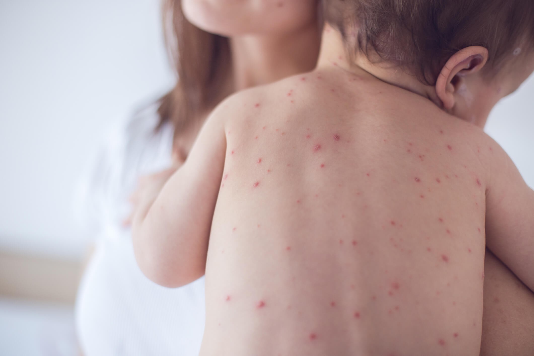 อีสุกอีใส (Chickenpox, Varicella)