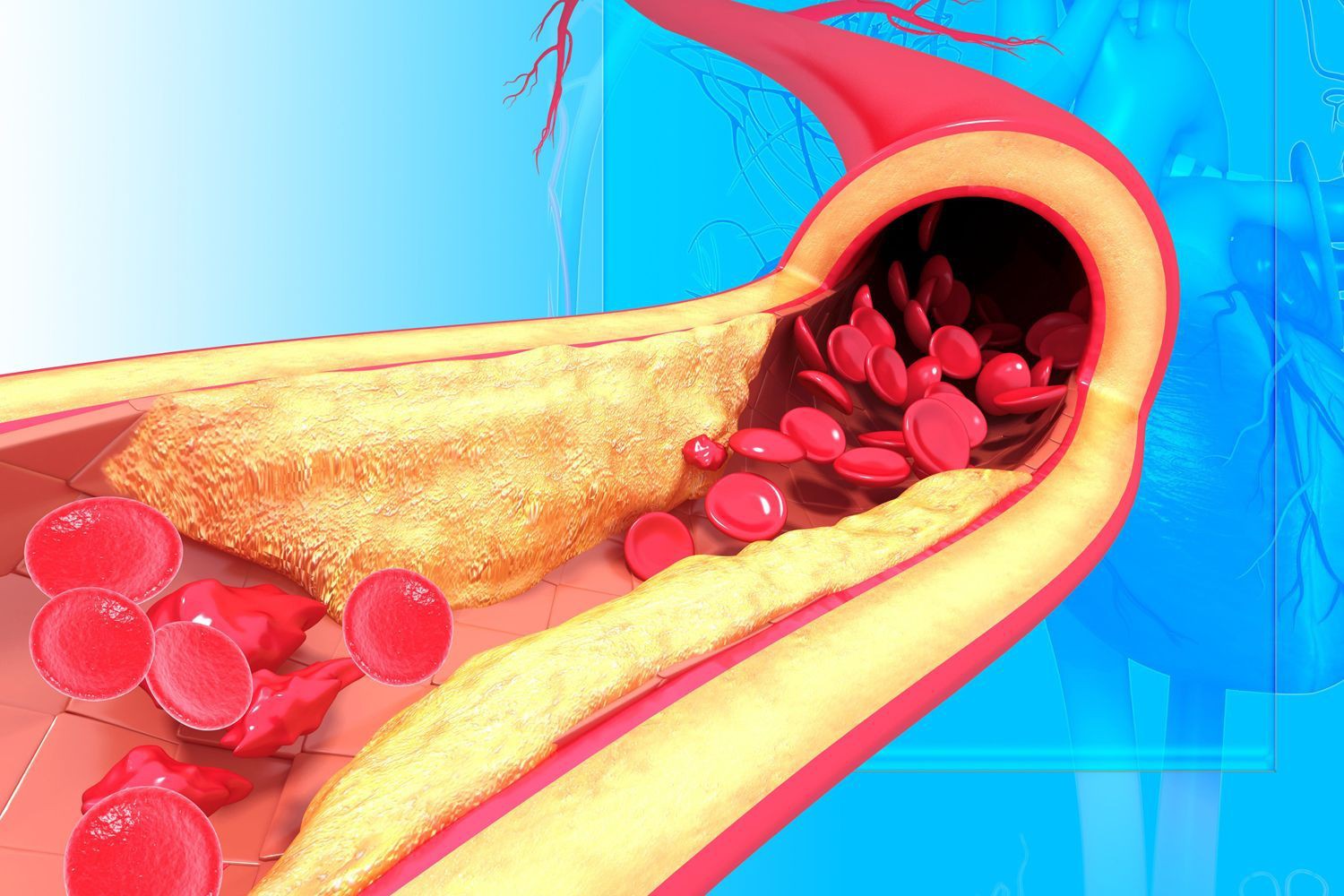 ภาวะไขมันในเลือดสูง (Hypercholesterolemia)