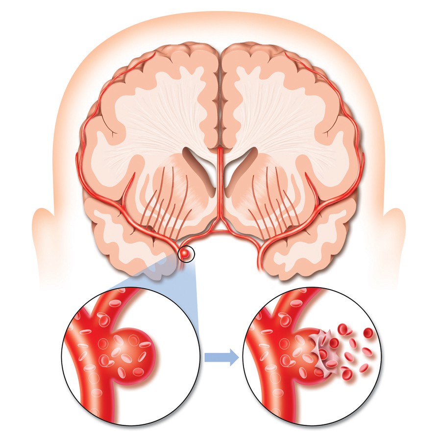 โรคหลอดเลือดสมอง (Stroke or cerebrovascular disease)