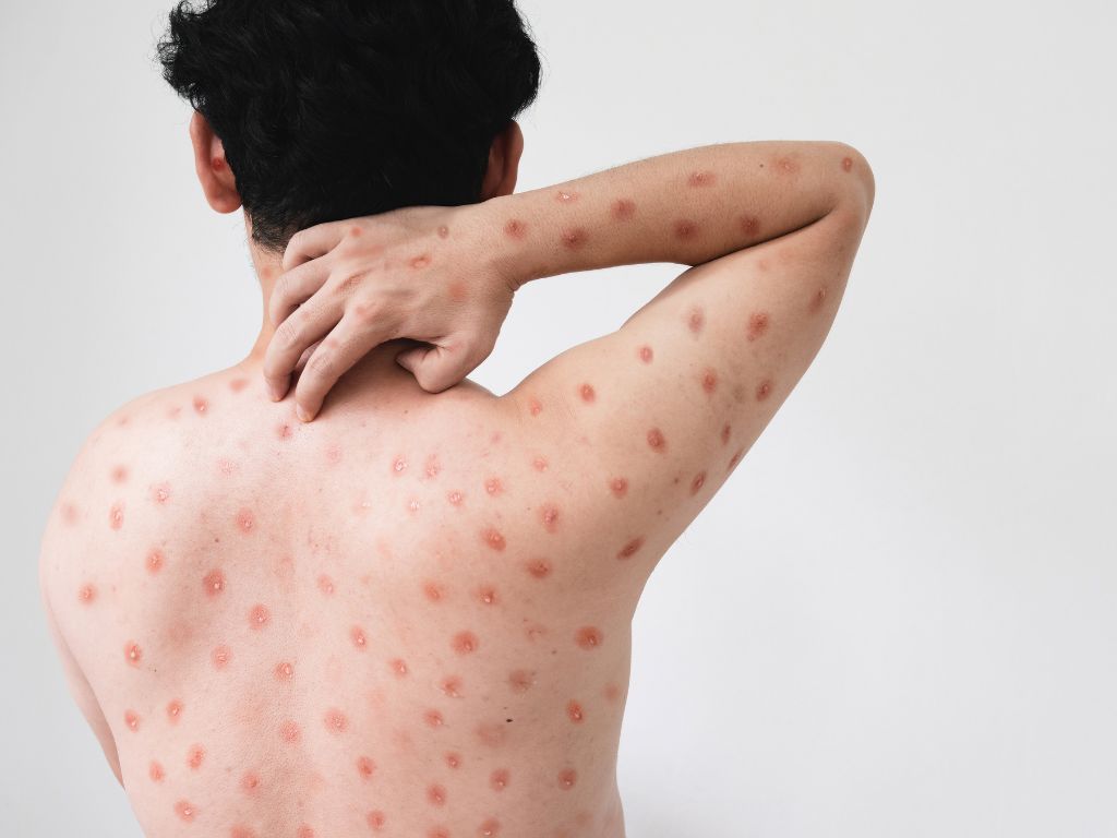 โรคฝีดาษวานร  (Monkeypox)