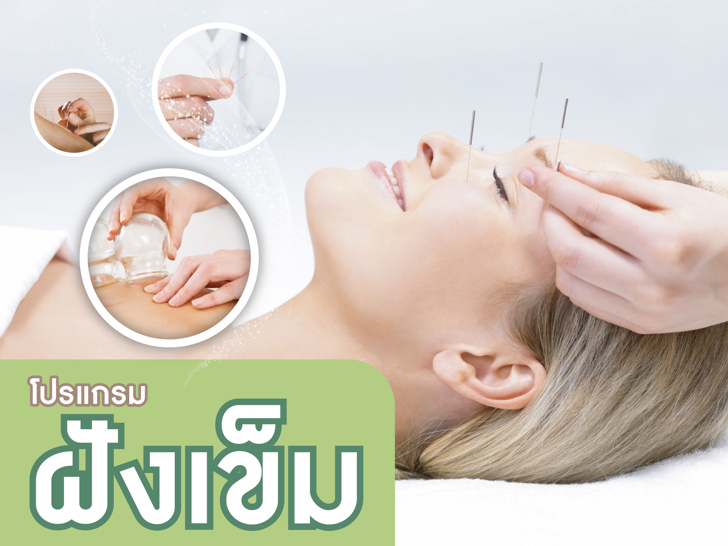 ฝังเข็ม